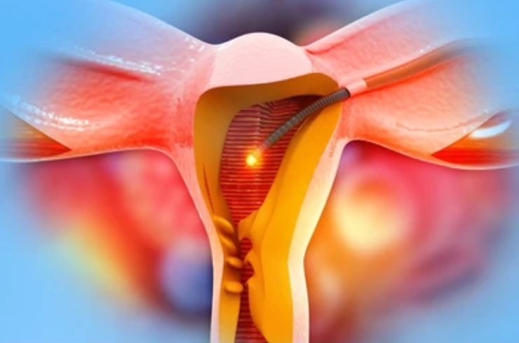 Hysteroscopy------23