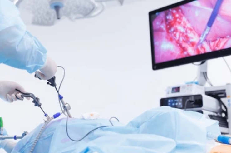 Laparoscopy------23